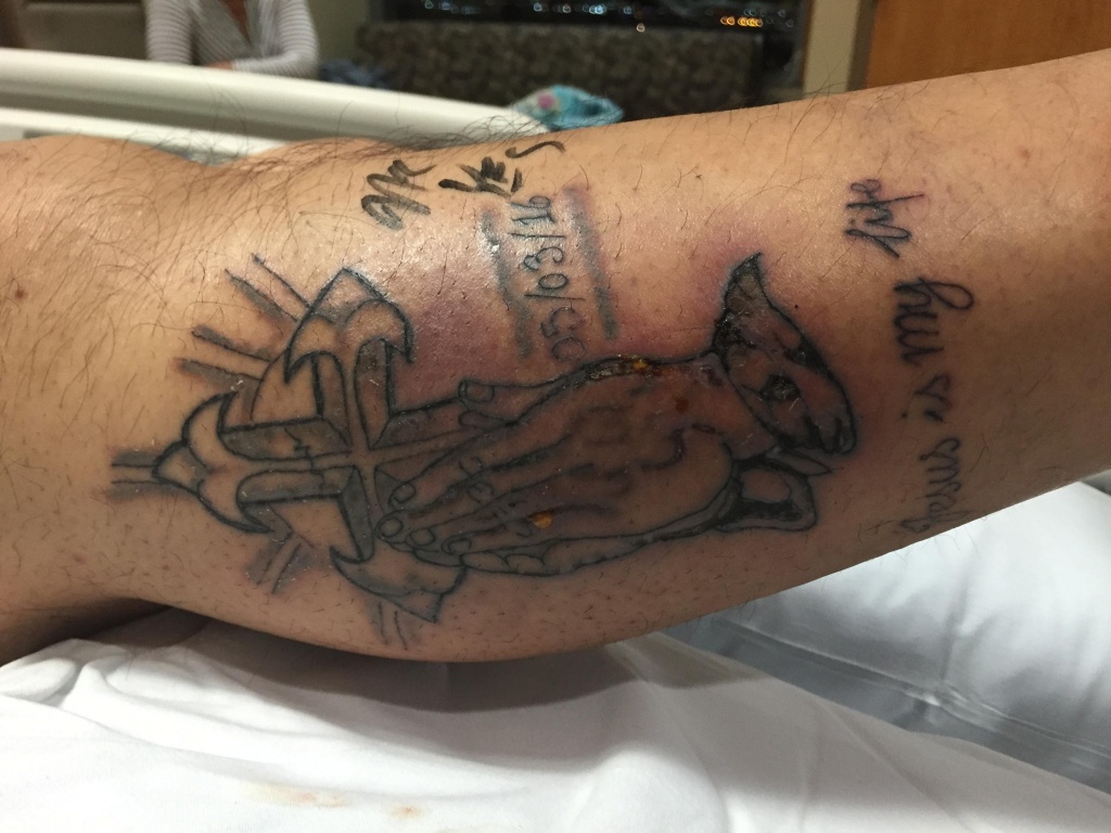 Man Dies After Flesh-Eating Bacteria Infects New Tattoo - Cbs News - Flesh Eating Bacteria Florida 2017 Map